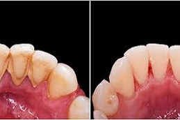 Teeth Scaling Before and After,