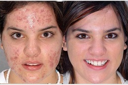 milia treatment before and after clinic islamabad