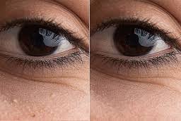 milia treatment before and after in Islamabad