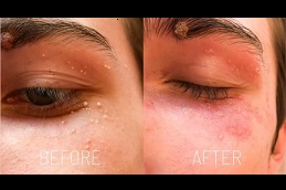 milia treatment before and after islamabad