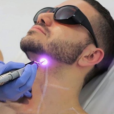 Beard Line Laser Hair Removal in Islamabad Pakistan