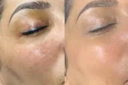 Results OF BB Glow Treatment Clinic in Islamabad