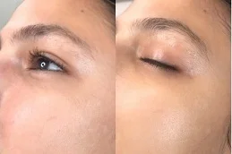 Results OF BB Glow Treatment Islamabad