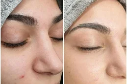 Results OF BB Glow Treatment in Islamabad