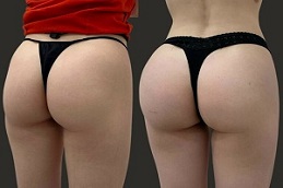 Results OF Butt Fillers Islamabad