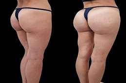 Results OF Butt Fillers clinic Islamabad