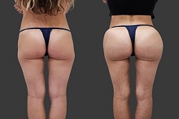 Results OF Butt Fillers in Islamabad