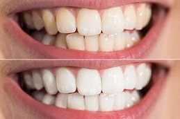 Results OF Hydrogen Peroxide Teeth Whitening Islamabad