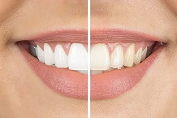 Results OF Hydrogen Peroxide Teeth Whitening clinic Islamabad