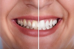 Results OF Hydrogen Peroxide Teeth Whitening in Islamabad