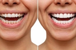 Results OF Lingual Braces clinic in Islamabad