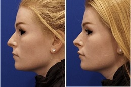 Results OF Liquid Rhinoplasty Islamabad