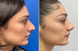 Results OF Liquid Rhinoplasty clinic Islamabad