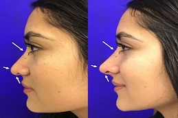 Results OF Liquid Rhinoplasty in Islamabad