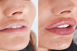 Results OF Russian Lip Fillers clinic Islamabad