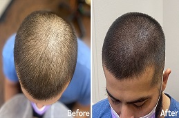 Results OF Scalp Micropigmentation Islamabad Pakistan