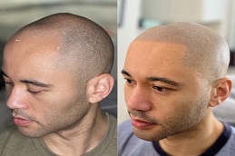 Results OF Scalp Micropigmentation clinic Islamabad