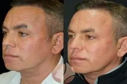 Results OF Thread Lift Treatments Islamabad