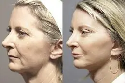Results OF Thread Lift Treatments clinic in Islamabad