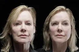 Results OF Thread Lift Treatments in Islamabad