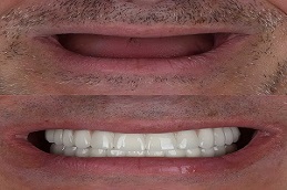 Results of Dental Implants Islamabad