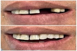 Results of Dental Implants clinic in Islamabad