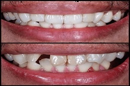 Results of Dental Implants in Islamabad