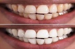 Results of Hollywood Smile Islamabad
