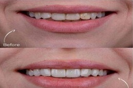 Results of Hollywood Smile clinic Islamabad