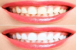 Results of Hollywood Smile in clinic Islamabad