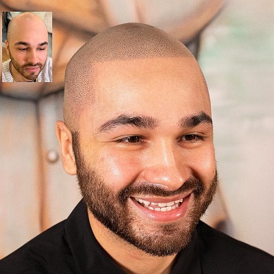 Scalp Micropigmentation Cost Pakistan