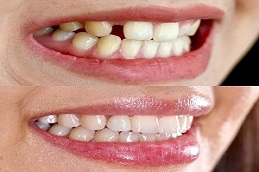 Teeth Aligners Before & After in islamabad