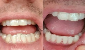 Teeth Aligners Before & After in islamabad,