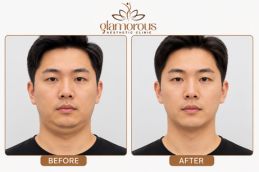 Before After result of chin liposuction in Islamabad Pakistan