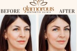 Before and After Browlift in Islamabad