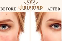 Before and After Browlift in Islamabad & Pakistan