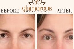 Before and After Browlift in Islamabad , Rawapindi & Pakistan
