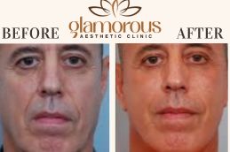 Before and After Browlift surgery in Islamabad ,Pakistan