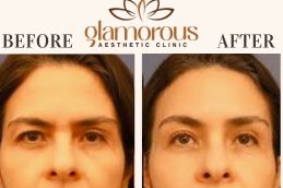 Before and After Browlift surgery in Islamabad , Rawapindi & Pakistan