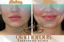 Before and After Dimple creation in Islamabad , Rawalpindi & Pakistan