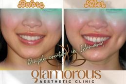 Before and After Dimple creation surgery in Islamabad , Rawalpindi & Pakistan