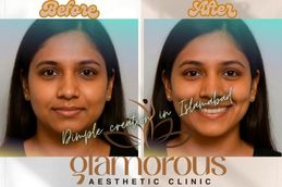 Before and After Dimple creation surgery in Islamabad , Rawalpindi