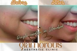 Before and After Dimple creation surgery in Islamabad
