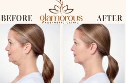 Before and After DoubleChin removal in Islamabad ,Pakistan