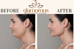 Before and After DoubleChin removal in Islamabad , Rawalpindi &Pakistan