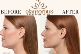 Before and After DoubleChin removal surgery in Islamabad ,Pakistan