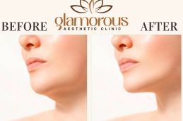 Before and After Facelift in Islamabad