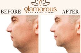 Before and After Facelift in Islamabad & Pakistan