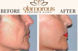 Before and After Facelift in Islamabad & Pakistan
