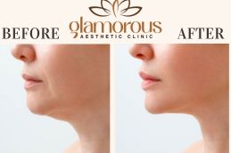 Before and After Facelift in Islamabad Rawalpindi